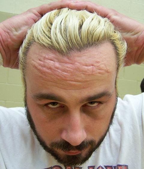 WWE medics puzzled by 100% decline in small gashes to the forehead