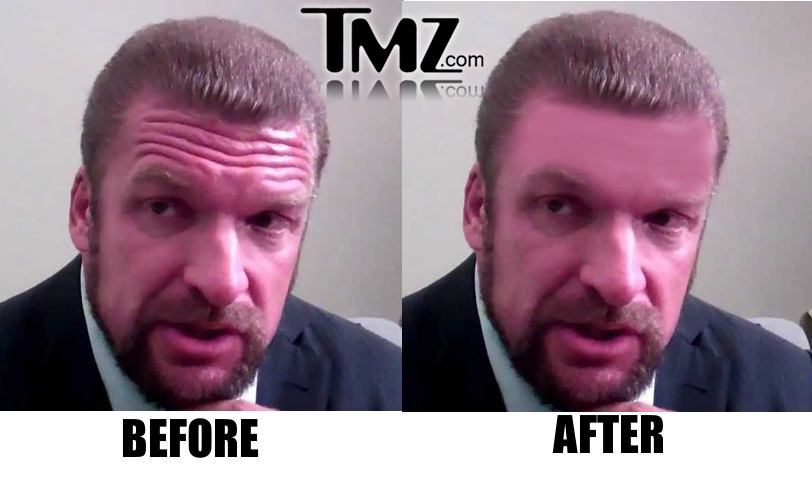 Triple-H gets brow surgically unfurrowed