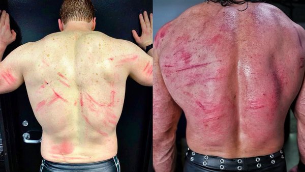 Here’s the secret method pro wrestlers use to create fake “welts” on their bodies